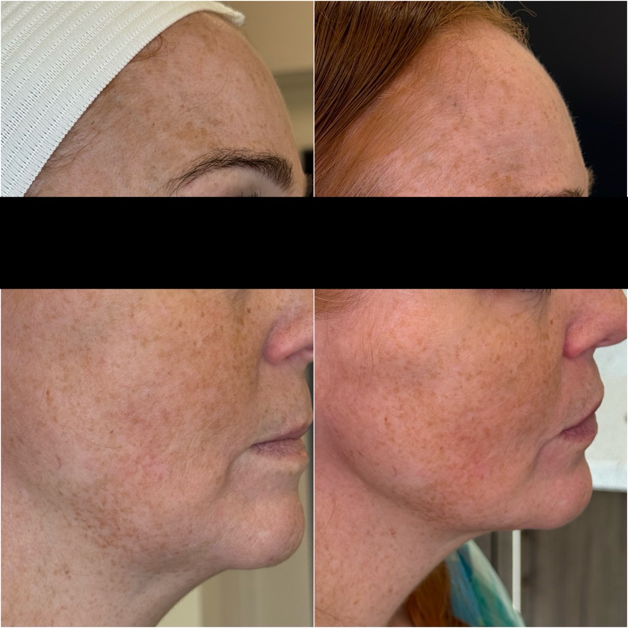 Facial Balancing result 1