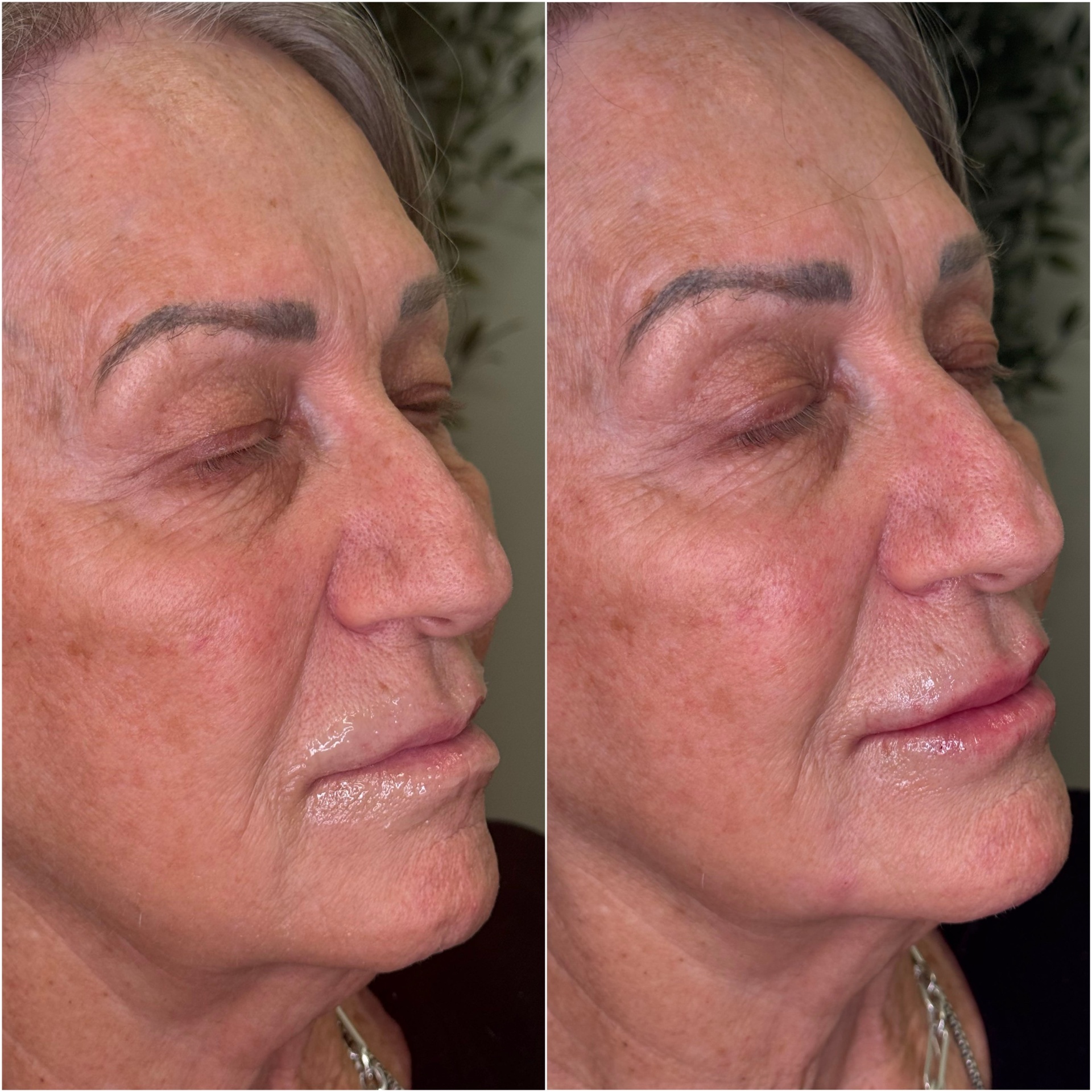 Facial Balancing result 2