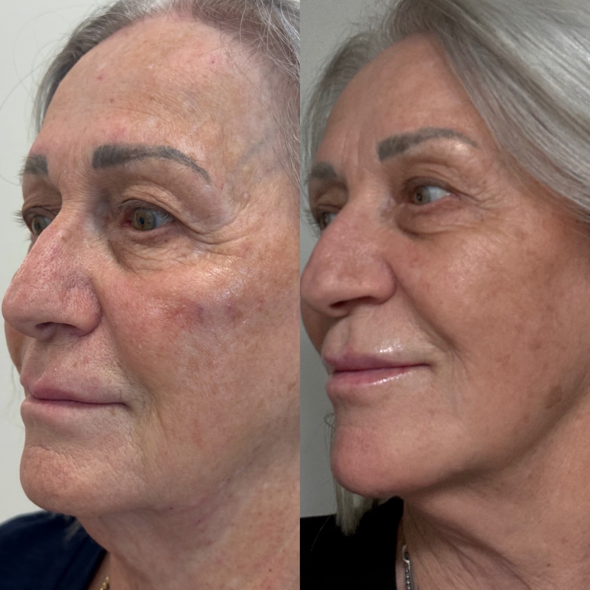 Facial Balancing result 3