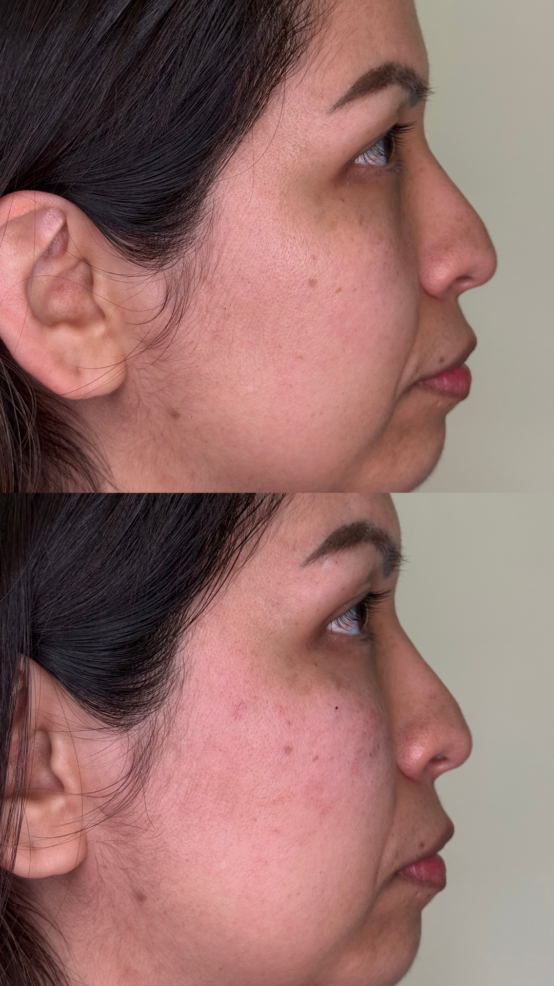 Facial Balancing result 4