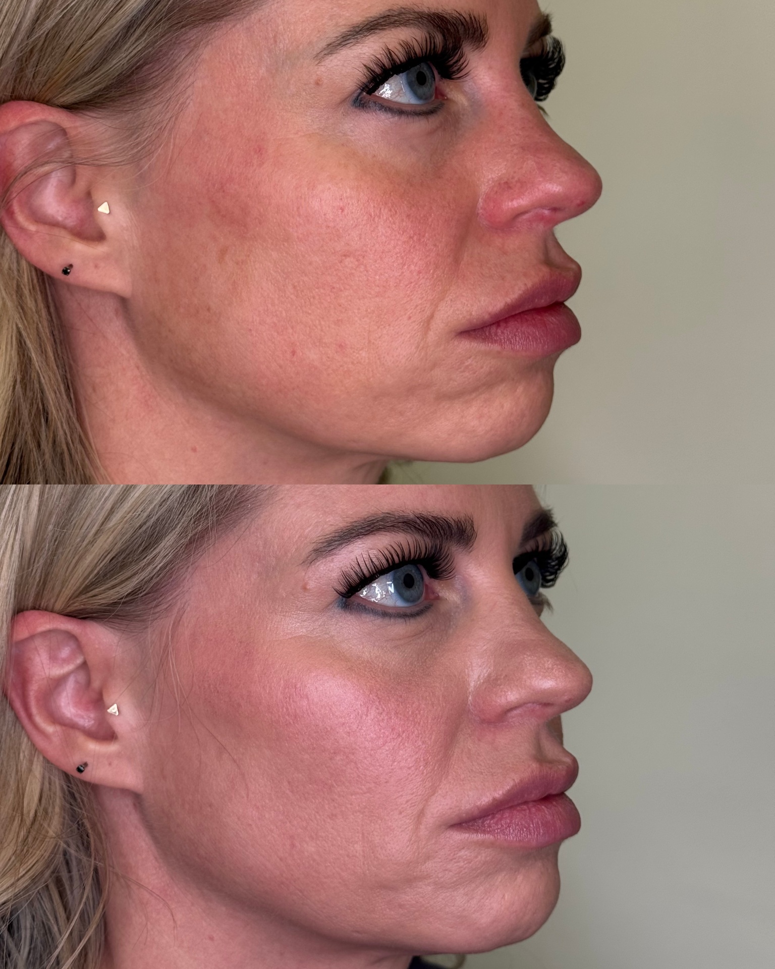 Facial Balancing result 5