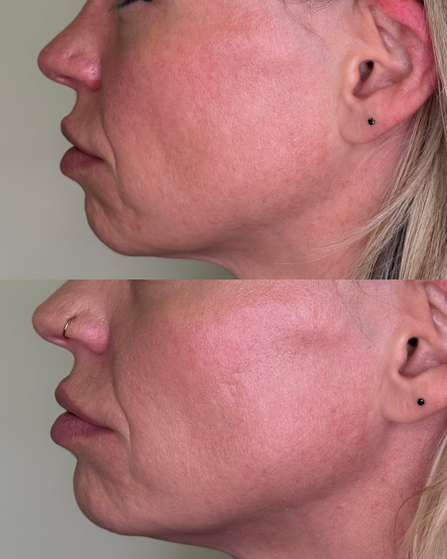 Facial Balancing result 6